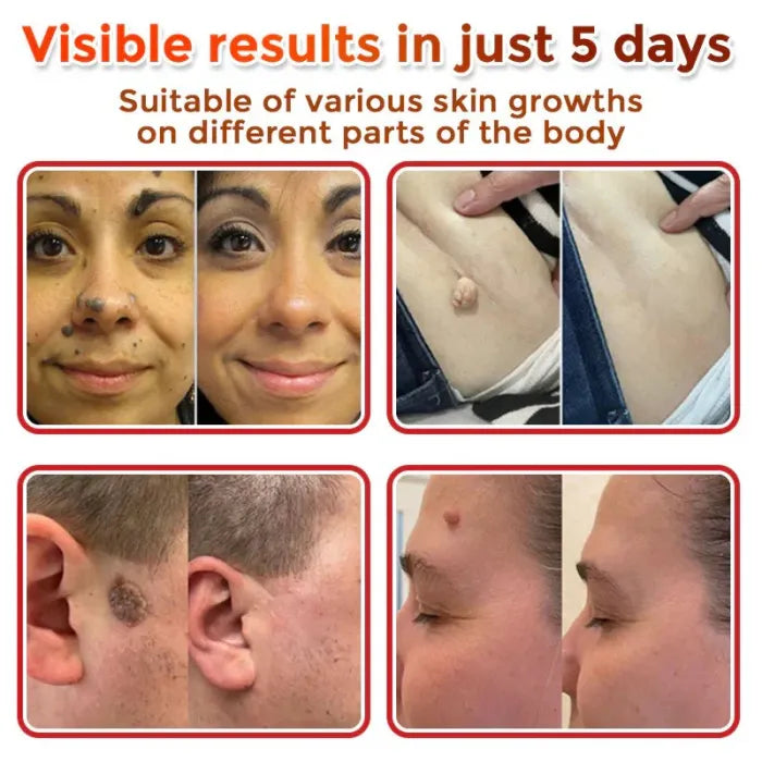 LBMLBM® MicroNeedle Botanic Skin Tag Removal Patch