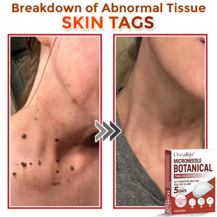 LBMLBM® MicroNeedle Botanic Skin Tag Removal Patch